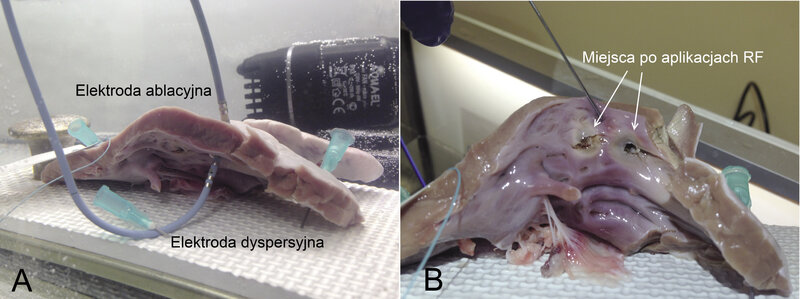 Ryc. 1. A. W czasie ablacji „in vitro” stosowano wet-lab wypełniony roztworem fizjologicznym o temperaturze 36°C oraz z wymuszonym przepływem roztworu, tak aby imitować warunki naturalne. Elektroda ablacyjna była obciążana 10 oraz 20 g (jest to zakres siły nacisku stosowany w czasie zabiegów, gwarantujący najlepszy kontakt elektrody z tkanką) i aplikacje były wykonywane przy zastosowaniu mocy 20-40 W przez 30-120 sekund. B. Po aplikacji miejsca były szczegółowo badane makroskopowo, oceniano wielkość uzyskanej blizny oraz obecność potencjalnie niebezpiecznych „popów” i uszkodzenia mechanicznego tkanki.