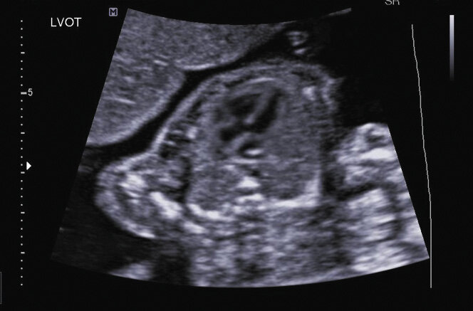 Rycina 23. Aorta odchodząca znad obu komór (aorta jeździec) w tetralogii Fallota w drugim trymestrze ciąży