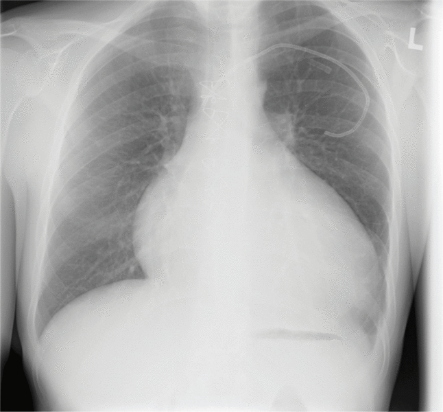 Rycina 2. Zdjęcie radiologiczne chorego po transplantacji serca.