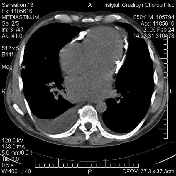 Rycina 2. Tomografia komputerowa klatki piersiowej z kontrastem. Masywne zwapnienia w worku osierdziowym u chorego z zaciskającym zapaleniem osierdzia o etiologii gruźliczej.
