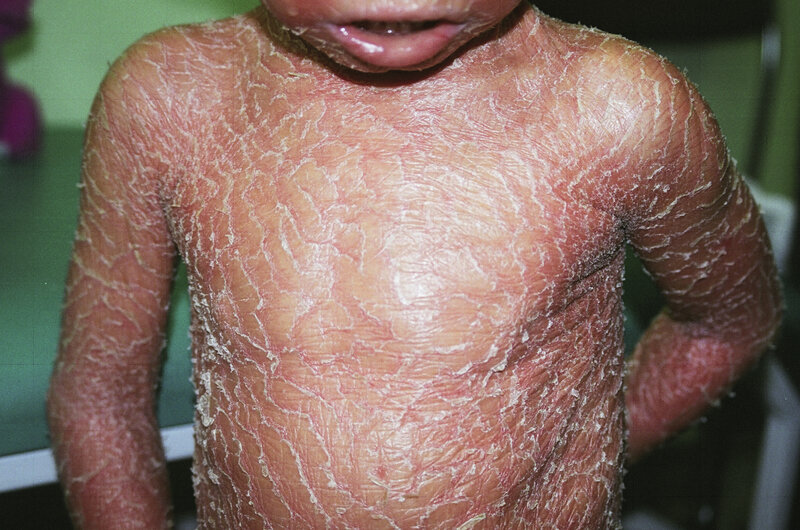 Rycina 9. Erytrodermia w rybiej łusce sprzężona z chromosomem X.