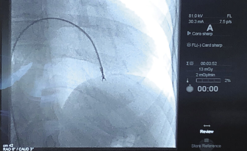 Ryc. 2. Pobranie bioptatu mięśnia sercowego z prawej komory serca z dostępu od prawej żyły udowej.