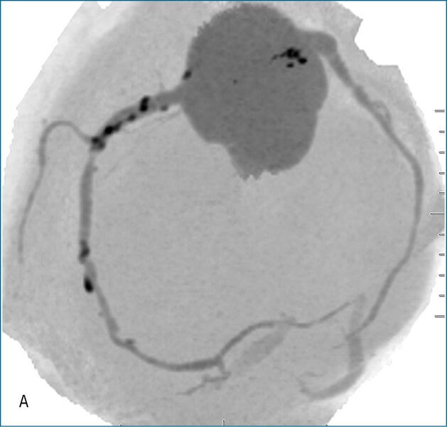 Rycina 2. Badanie tętnic wieńcowych metodą tomografii komputerowej. A. Rekonstrukcja MIP Inwers (maksimum intensity projection) – widoczne wielopoziomowe zmiany w prawej tętnicy wieńcowej. B. Warstwa poprzeczna (axial) – obraz remodelingu dodatniego ściany naczynia w segmencie 3 prawej tętnicy wieńcowej; blaszka niskiej gęstości zwęża światło w 40%, jednak jej faktyczna wielkość ukryta jest dzięki modelowaniu ściany naczynia na zewnątrz.