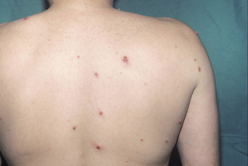 Ryc. 6. Bakteryjna naczyniakowatość (bacillary angiomatosis) u pacjenta po transplantacji serca imitująca mięczaka zakaźnego.