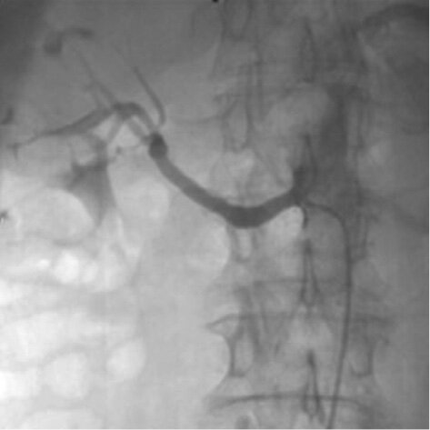 Rycina. Angiogramy nerki. Po stronie lewej – ciężkie zwężenie ujścia prawej tętnicy nerkowej. Po stronie prawej – stan po przezskórnej angioplastyce z implantacją stentu w prawej tętnicy nerkowej.