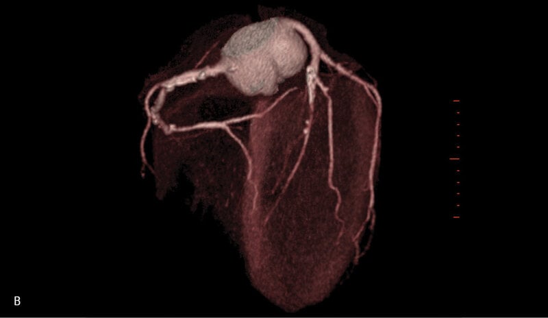 Rycina 1. Badanie tętnic wieńcowych metodą tomografii komputerowej. A. Rekonstrukcja MIP Inwers (maximum intensity projection) – widoczne liczne zwapnienia w lewej tętnicy wieńcowej oraz krytyczne zwężenie w jej środkowym segmencie. B. Rekonstrukcja VR (volume rendering) – krytyczne zwężenie środkowego segmentu lewej tętnicy wieńcowej oraz gałęzi diagonalnej. C. Warstwa poprzeczna (axial) – widoczna blaszka niskiej gęstości wypełniająca światło segmentu środkowego lewej tętnicy wieńcowej.