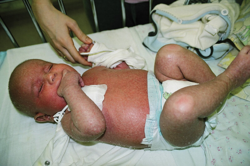 Rycina 2. Erytrodemia u dziecka z ciężkim złożonym niedoborem odporności (w zespole Omenna).