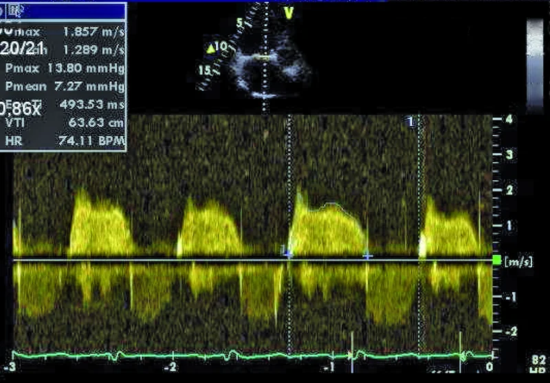 Rycina 3. Tryb doplera ciągłego. Projekcja koniuszkowa czterojamowa (zmodyfikowana).