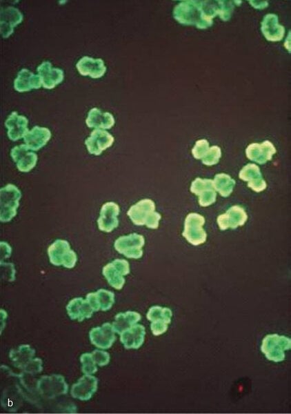 Rycina 1. Identyfikacja przeciwciał przeciwko cytoplazmie neutrofilów (ANCA) metodą immunofluorescencji pośredniej. (a) ANCA typ cytoplazmatyczny: dodatnie znakowanie w cytoplazmie neutrofilów z obecnością ziarnistości i immunofluorescencją pomiędzy segmentami jąder komórkowych. (b) ANCA typ okołojądrowy: immunofluorescencja widoczna wokół jąder neutrofilów.
