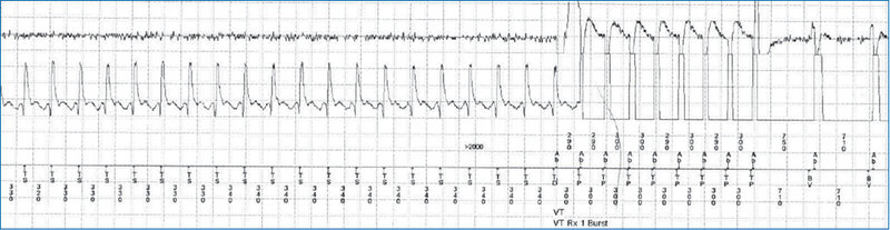 Rycina 1. Zapis elektrograficzny (EGM) u chorego z ICD i częstoskurczem komorowym prawidłowo zdetekowanym przez urządzenie. Prawidłowo rozpoznany przez urządzenie częstoskurcz komorowy zostaje przerwany przez terapię antytachyarytmiczną (Burst)