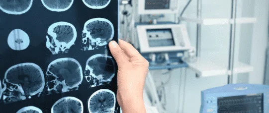 Trombektomie muszą być procedurą gwarantowaną?
