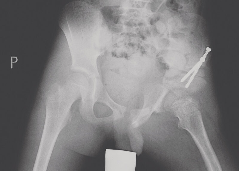 Ryc. 4. Zdjęcie rtg miednicy dziewięcioletniego chłopca po operacji super hip/super knee lewego biodra z potrójną osteotomią miednicy.
