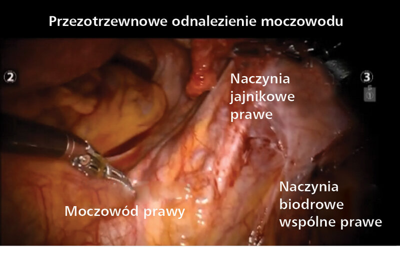 Film wideo 1. Pięć etapów histerektomii z użyciem robota