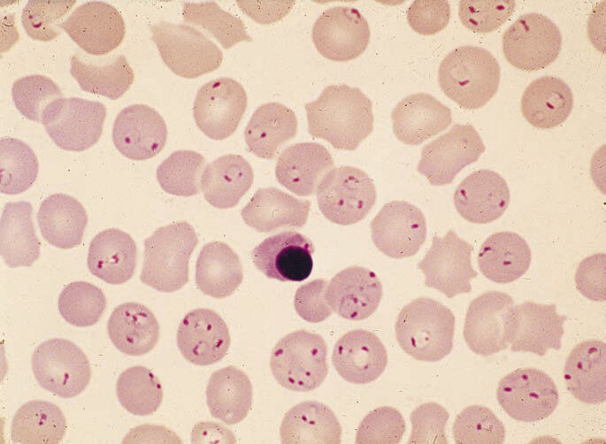 Rycina 1. Hiperparazytemia Plasmodium falciparum w rozmazie krwi