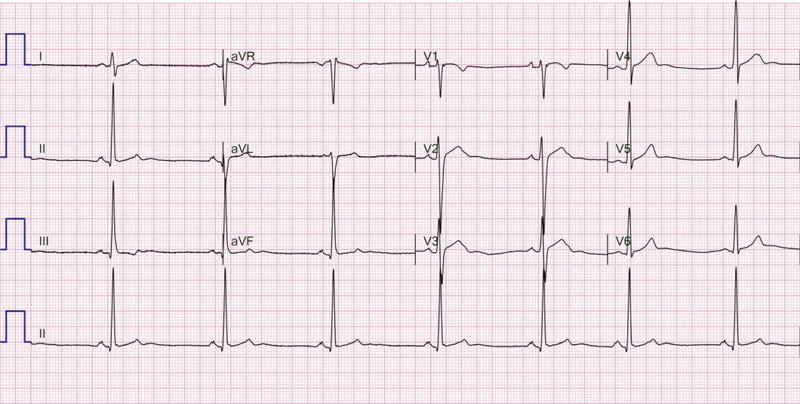 Rycina 1. Zapis 12-kanałowego EKG 36-letniego sportowca ze zdiagnozowaną arytmogenną kardiomiopatią prawokomorową, u którego w rezonansie magnetycznym serca stwierdzono regionalne zaburzenia kurczliwości prawej komory. W zapisie widoczne TAD (terminal activation delay) 63 ms w odprowadzeniach V1 i V2