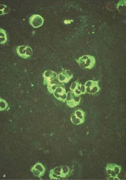 Rycina 1. Identyfikacja przeciwciał przeciwko cytoplazmie neutrofilów (ANCA) metodą immunofluorescencji pośredniej. (a) ANCA typ cytoplazmatyczny: dodatnie znakowanie w cytoplazmie neutrofilów z obecnością ziarnistości i immunofluorescencją pomiędzy segmentami jąder komórkowych. (b) ANCA typ okołojądrowy: immunofluorescencja widoczna wokół jąder neutrofilów.