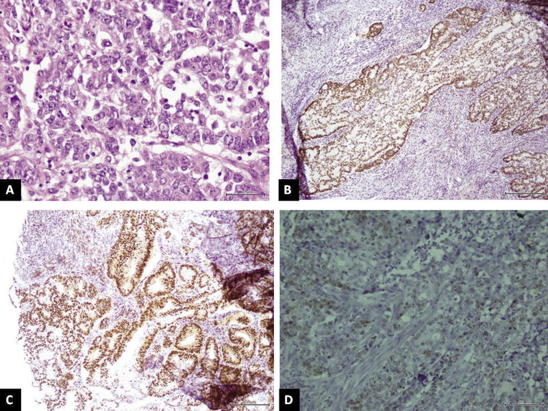 Ryc. 4. Obrazy mikroskopowe gruczolakoraka endometrium  w metodzie TMA: A – bawienie H+E (powiększenie 400 x), B – silna ekspresja receptorów estrogenowych (powiększenie 200 x), C – silna ekspresja receptorów progesteronowych (powiększenie 200 x),  D – silna ekspresja Ki67 (powiększenie 200 x).