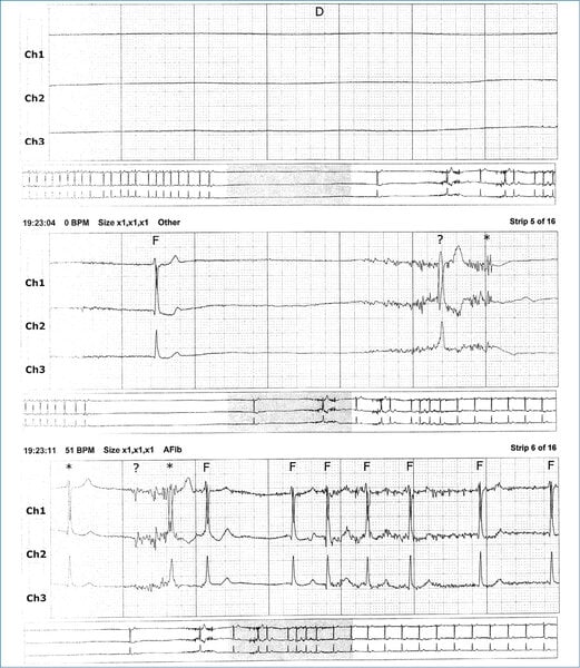 Rycina 1. Fragment zapisu EKG rejestracji całodobowej przedstawia pauzę o długości kilkunastu sekund, po której następuje wstawka epizodu migotania przedsionków i powrót rytmu zatokowego