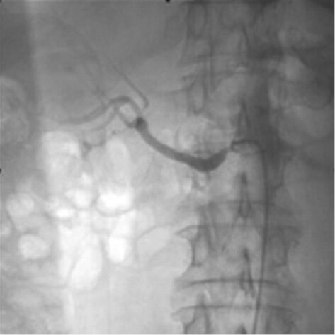 Rycina. Angiogramy nerki. Po stronie lewej – ciężkie zwężenie ujścia prawej tętnicy nerkowej. Po stronie prawej – stan po przezskórnej angioplastyce z implantacją stentu w prawej tętnicy nerkowej.