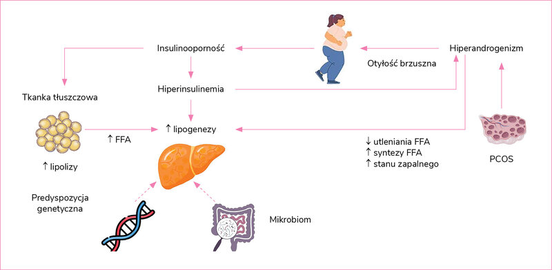 Rycina 2. Patogeneza stłuszczeniowej choroby wątroby związanej z dysfunkcją metaboliczną (MASLD) w zespole policystycznych jajników (PCOS)*