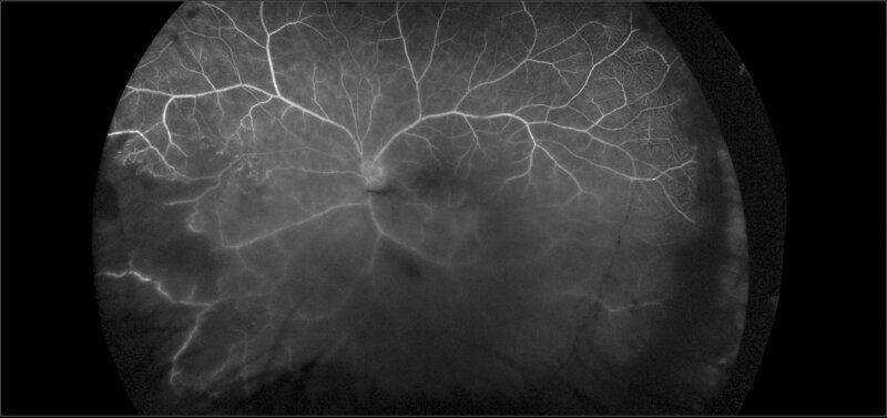 Ryc. 2. Angiogram naczyń siatkówki w zakresie 200 stopni. Badanie wykonano mimo utrudnionego wglądu w dno oka z powodu stanu zapalnego ciała szklistego. Widoczny brak wypełnienia się łożyska naczyniowego w obwodowej dolnej części siatkówki.