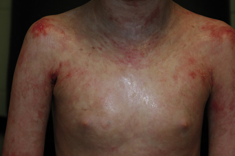 Rycina 11. Erytrodermia u chorego po przeszczepieniu macierzystych komórek krwi obwodowej z powodu SCID.