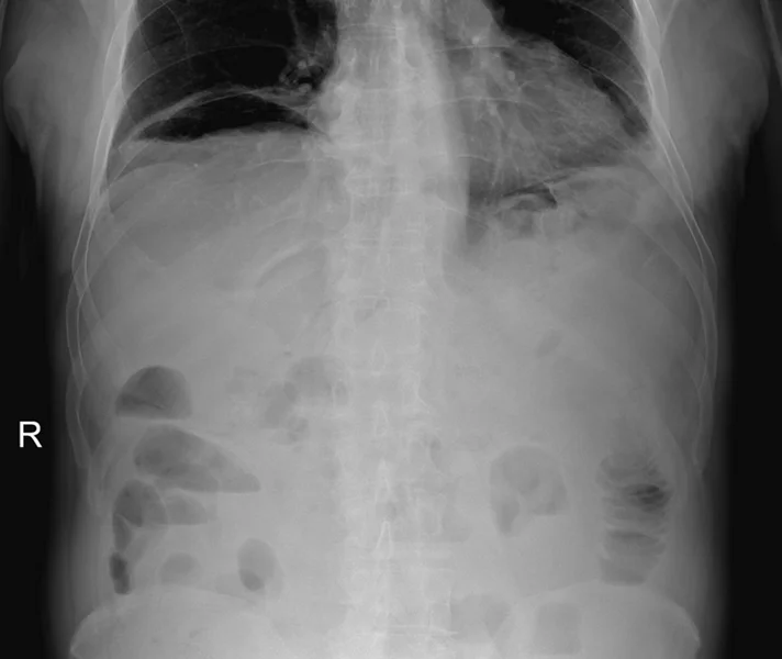 Rycina 5. Perforacja po ECPW – typowy obraz radiologiczny z charakterystycznym sierpem powietrza pod przeponą