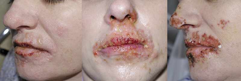 Rycina 1. Herpes labialis. Reaktywacja HSV wzdłuż gałązki 3 nerwu V. Zmiany w kolejnych dniach.