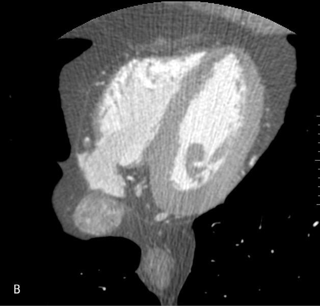 Rycina 2. Badanie tętnic wieńcowych metodą tomografii komputerowej. A. Rekonstrukcja MIP Inwers (maksimum intensity projection) – widoczne wielopoziomowe zmiany w prawej tętnicy wieńcowej. B. Warstwa poprzeczna (axial) – obraz remodelingu dodatniego ściany naczynia w segmencie 3 prawej tętnicy wieńcowej; blaszka niskiej gęstości zwęża światło w 40%, jednak jej faktyczna wielkość ukryta jest dzięki modelowaniu ściany naczynia na zewnątrz.