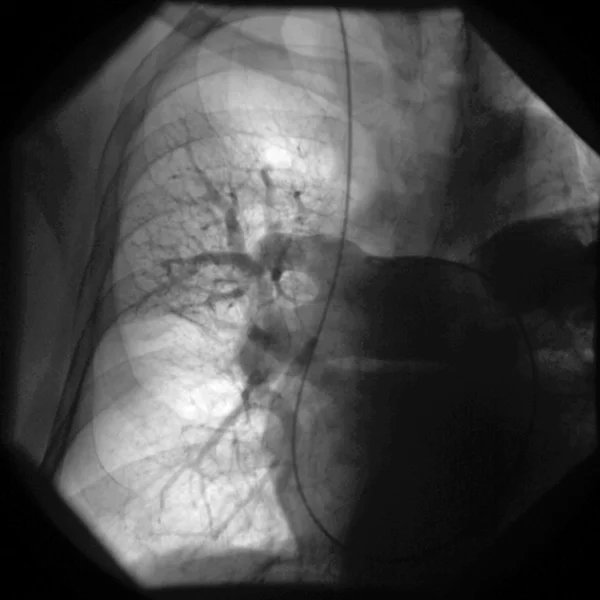 Rycina 3. Arteriografia kontrastowa tętnicy płucnej. Prawie całkowity brak unaczynienia płuca prawego. Widoczne nieliczne tętnice płucne u podstawy płata górnego płuca prawego.