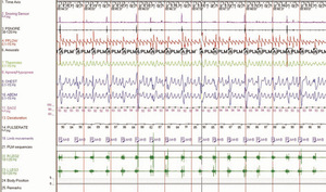 Small original anderson 2 opt