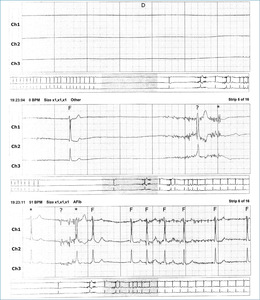 Small holter fmt