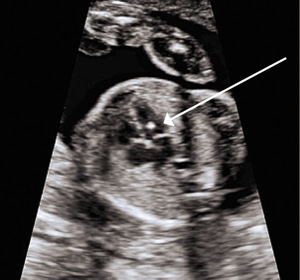 Small smfm consult obgyn0813 opt