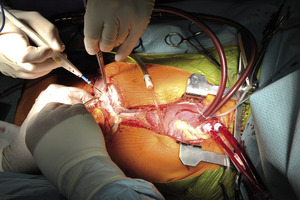 Small 01 otwarta klatka pier opt