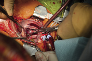 Small 02 usuwanie czopu z pr opt