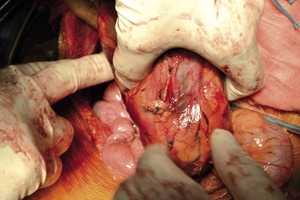 Small 03 wyciaganie nerki z opt