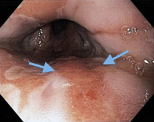 Small ryc 02 rak gruczolowy opt
