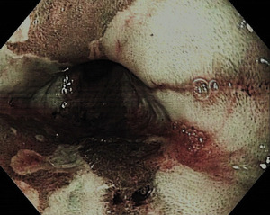 Small ryc 03 rak gruczolowy opt