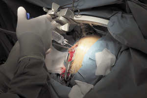 Small operacja parkinson 025 opt