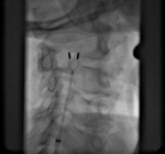Small 02 cewnik ablacyjny opt