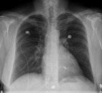 Small mitraclip 1 opt