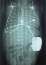 Small rtg z rozrusznikiem opt