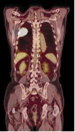 Small 2 med trib rak pluca opt