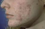 Small 3406 cystic acne of th opt