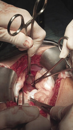 Small wytrzewienie przez po opt1