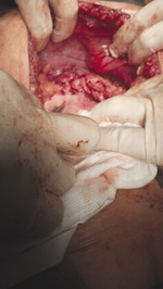 Small wytrzewienie przez po opt2