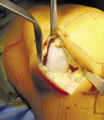 Small ryc 1ubytek miejscowy opt