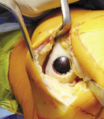 Small ryc 2 ubytek miejscow opt