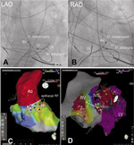 Small bipolar ablation   ryc opt