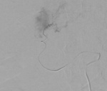 Small arteriografia opt